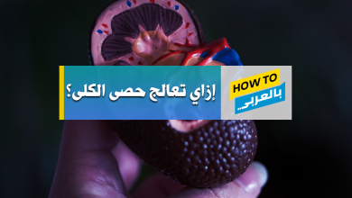 حصى الكلى