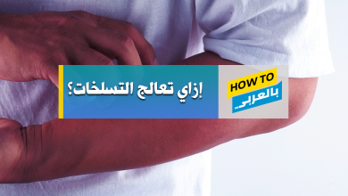 علاج التسلخات
