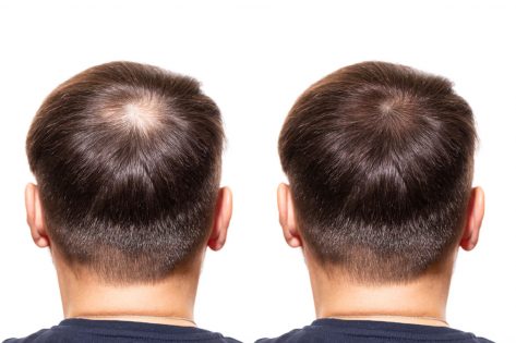 زراعة الشعر