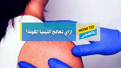 علاج التينيا الملونة